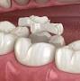 Resin inlay dental from smilesdental.com
