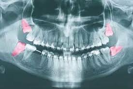 How much does removal cost? Wisdom Teeth Extraction Wisdom Teeth Removal Vancouer Wa Camas Wa