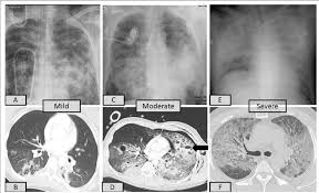 Image result for Pulmonary Contusion