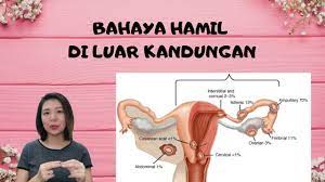 Biasanya tanda hendak period ini sangat serupa dengan tanda hamil. Hamil Ektopik Hamil Di Luar Kandungan Youtube