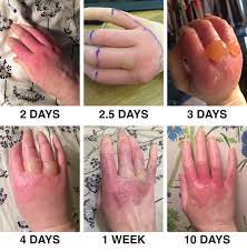 Many chemical burns are small, but they can be deeper than they look. Phytophotodermatitis Wikipedia
