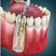 Root Canal Treatment( RCT) product image