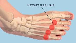 Image result for Metatarsalgia