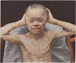 Image result for Ichthyosis