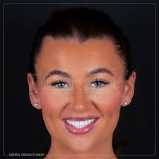 Dental Design Turkey Antalya (@dentaldesignturkey) · Instagram 照片和视频