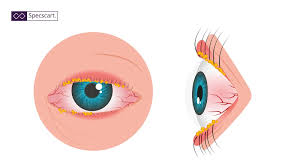 Image result for Eye Discharge