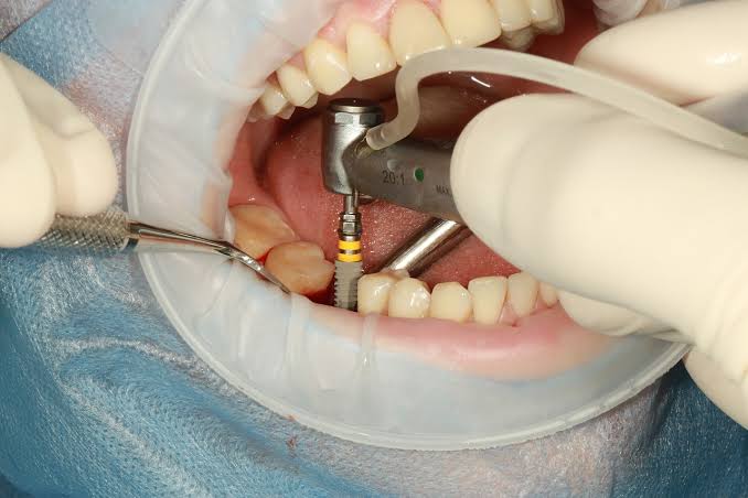 DENTAL IMPLANTS