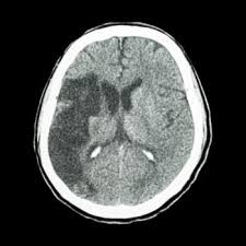 The cat scan machine, often referred to as the ct machine, consists of a horizontal pad on which the patient lies. Ct Scans Can Predict Risk Of Stroke In Tia Patients