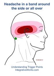 Pin Di Headache Trigger Point Pain