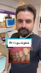 ‏ما سبب ظهور الخطوط السوداء على الأسنان؟ #dentist #fybシ #foryou #viral