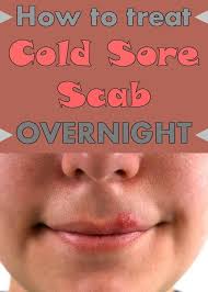 Check spelling or type a new query. Thebeautymania Net Nbspthebeautymania Resources And Information Cold Sore Scab Cold Sores Remedies Canker Sore