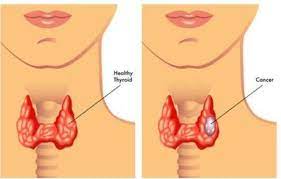 The most common symptom of esophageal cancer is trouble swallowing, especially a feeling of food stuck in the throat. Head And Neck Cancer Symptoms Of Throat Cancer Kimaja Farwani