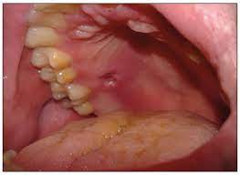 Herpes simplex encephalitis is a type of infectious encephalitis which happens when herpes simplex virus (hsv) enters the brain. Jordi Journal Of Oral Diagnosis