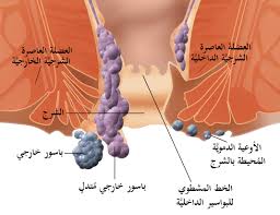 انواع البواسير والعوامل المسببة والعلاجات الدوائية والجراحية موقع الواحة