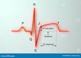 Image result for ST Segment
