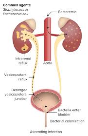 Image result for Perinephric Abscess