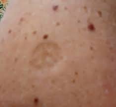 Chiedono l'iniezione sulla cicatrice del vaccino per il vaiolo Rossella Ao Ara On Twitter Vaccino Se C Hai Sto Segno Sul Braccio E Perche Hai Contribuito A Combattere Il Vaiolo Se Non Ce L Hai E Perche L Ho Fatto Io