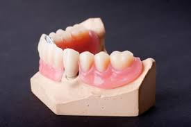 Cover denture prothesen sind deckprothesen und werden auch coverdenture, overdenture, hybridprothesen oder overlay denture genannt. Deckprothesen