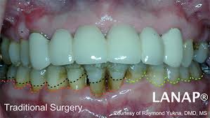 Help prevent tooth decay and future dental work. Why Is Lanap Making The Difference Preserve Your Teeth