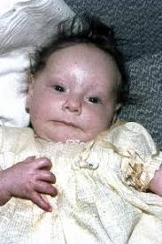 Polly's pages (aka 'Donna Williams') » Blog Archive » FASD, Autism and  neurological challenges