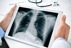 I cut any insurance company that was going to make you wait over a year for treatment — having to pay to wait around before your coverage goes into. Chest X Ray Reasons For Procedure Normal And Abnormal Results