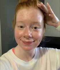 Jogging with cerebral palsy is a challenge