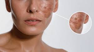 Image result for Diffuse Hyperpigmentation