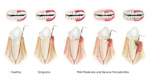Gum Disease Gingivitis And Periodontitis Dentist Advice