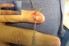 Image result for Glomus tumor