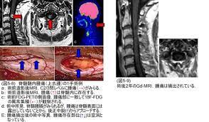 日記 薬剤 検査 手術 リンク. è„Šé«„è…«ç˜ ç·åˆå—æ±åŒ—ç—…é™¢
