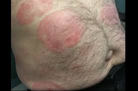 To identify ringworm, look for scaly, circular patches on your skin that may grow over time. Large Scaly Erythematous Patches Page 4 Of 4 Clinical Advisor