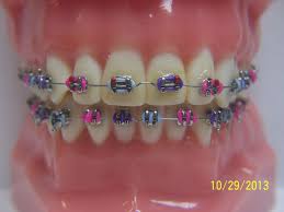 Fashionable Braces General Dentist Orthodontics Braces Braces Colors Orthodontics Braces Braces Colors Combinations