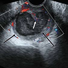Do you know what a smear test actually does? Nongynecologic Findings Seen At Pelvic Us Radiographics