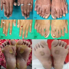 Image result for Onychogryphosis feet