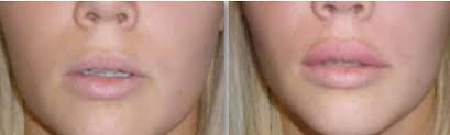 This filler is suitable for lip augmentation, wrinkles and nasolabial folds. Amalian Hyaluronic Acid Dermal Filler Information