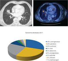 Malignant mesothelioma is a rare form of cancer typically caused by exposure to asbestos. Abstracts Dgt
