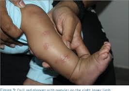 Image result for Papular urticaria