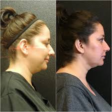 Pin On Kybella