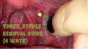 Hence try this tip on how to get rid of tonsil stones or home remedies for tonsil stones. How To Remove Tonsil Stones Tonsillitis At Home Youtube