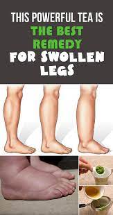 This Powerful Tea Is The Best Remedy For Swollen Legs Swollen Legs Foot Remedies Swollen Feet Remedy