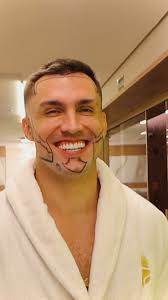 arthurpicoli no 3º Mês de Tratamento Capilar: Três meses após seu  transplante capilar, Arthur Picoli — retorna à clínica para um protocolo  que vai além do convencional. Desta vez, a estrela do