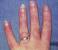 Hand Early Stage Lupus Rash