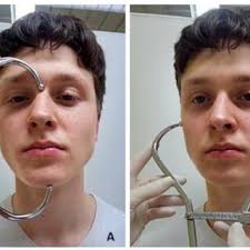 Surgically assisted rapid palatal expansion (SARPE) preference based on... 