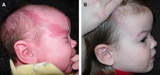 Management of Capillary Malformations