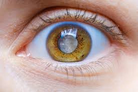 Image result for Glaucoma