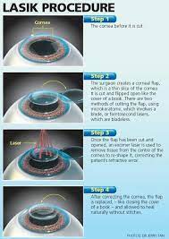 Pin By Cheryl Welch On Nursing Stuff Eye Surgery Laser Eye Surgery Lasik