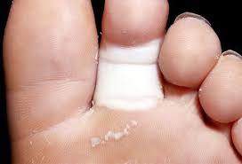 What Your Feet Say About Your Health Yeast Infection Neuropathy Raynauds