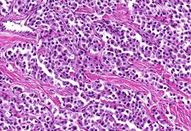 Image result for Chemodectoma