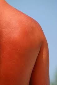 Image result for Sunburn