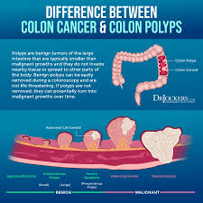 We did not find results for: Colon Cancer Symptoms Causes And Support Strategies